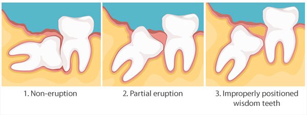 Wisdom Tooth Treatment in Paschim Vihar West Delhi