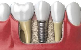 Dental Implant Centre