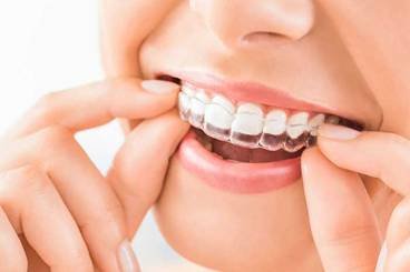 Cost of clear aligners or invisible braces in Delhi at Indiadens