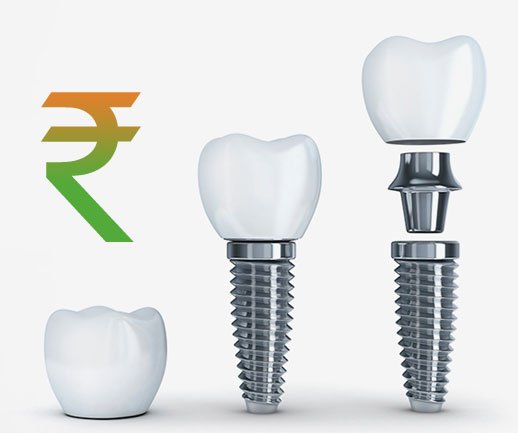 Dental Implants Cost in Delhi