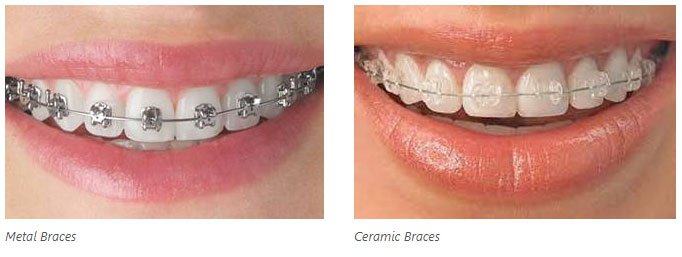 Braces vs Aligners: Which treatment is best for you? - Indiadens