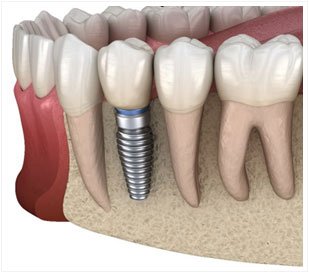 Dental Implant Treatment and Cost in India