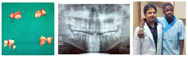 Extraction of four wisdom teeth and four supernumerary teeth in a single sitting by Dr Ujjwal Gulati