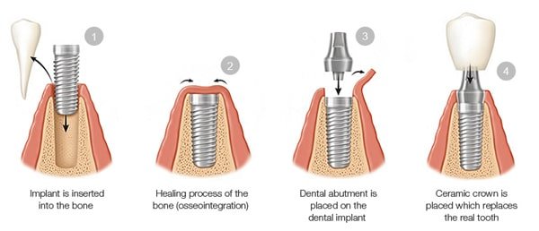 Dental Implant Treatment Phases