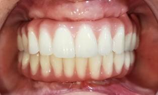 Dental Implant, Smile Correction