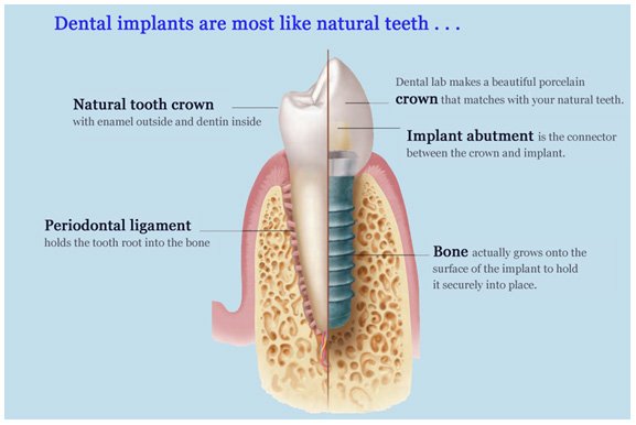 dental implants substitute the tooth roots