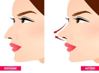Rhinoplasty, Cosmetic Surgery