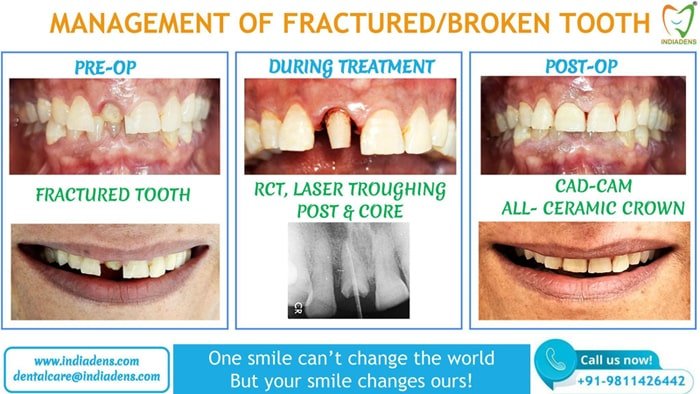 Management of Fractured / Broken Front Tooth At Indiadens