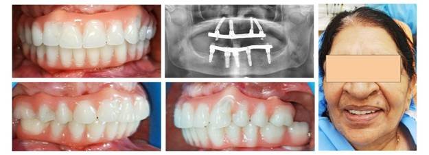 all on 5 technique dental implant