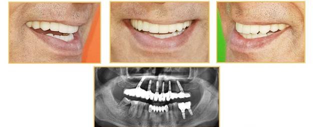 all on 6 dental implant technique