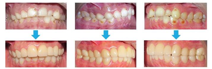 ceramic crowns