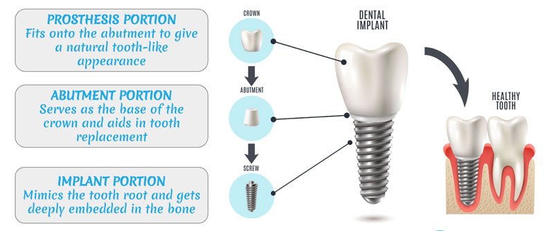 dental implants parts
