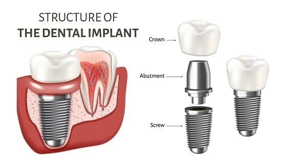 dental implants structure