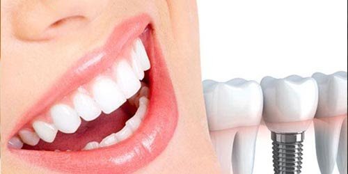 dental implants titanium screw
