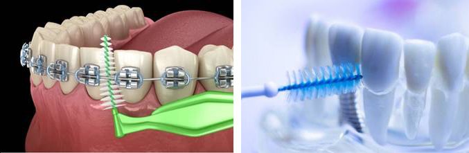 INTERDENTAL BRUSH USED TO CLEAN AROUND BRACES AND DENTAL IMPLANTS