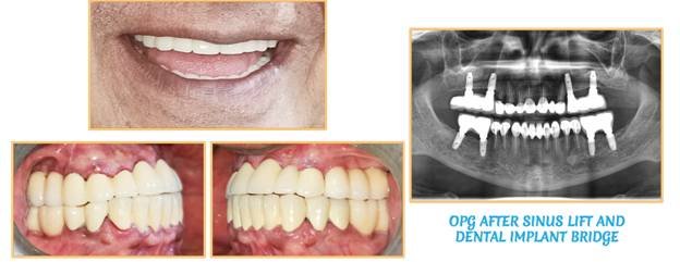 sinus lift and dental implant bridges