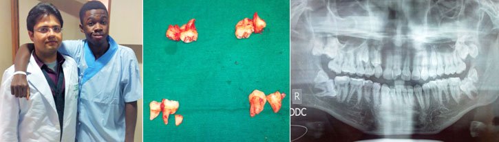 REMOVAL OF FOUR WISDOM TEETH & FOUR SUPERNUMERARY TEETH IN A SINGLE SITTING