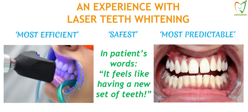 Laser Teeth Whitening Advanced Cosmetic Dentistry