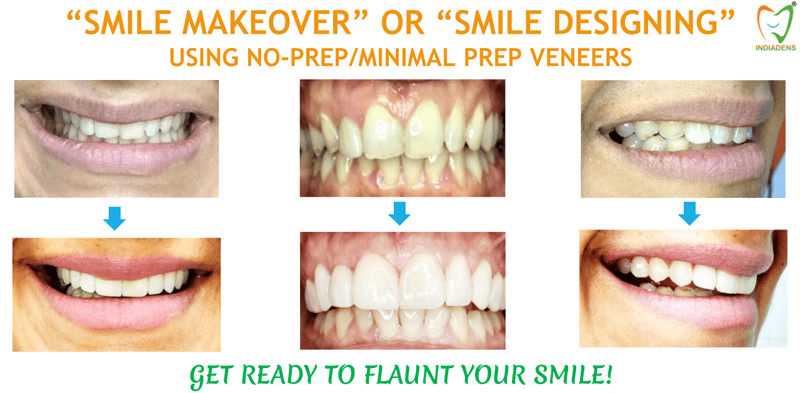 smile makeover designing advanced cosmetic dentistry