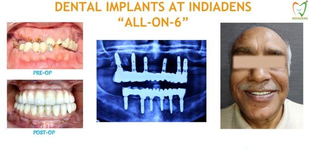 Dental Implants All on 6 Procedure