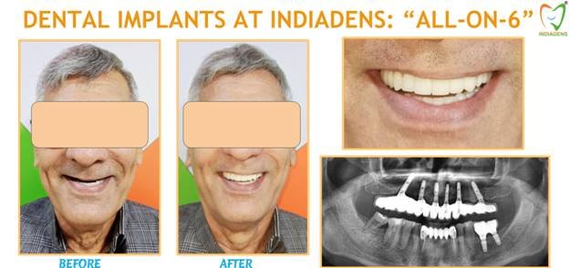 Dental Implants All on 6 Treatment by Dr Ujjwal Gulati Delhi India
