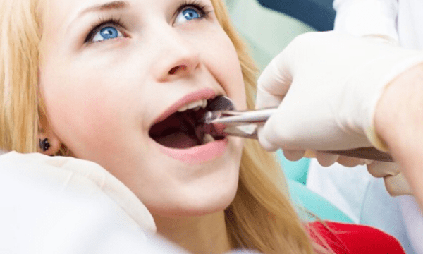 Extracting Wisdom Teeth Indiadens