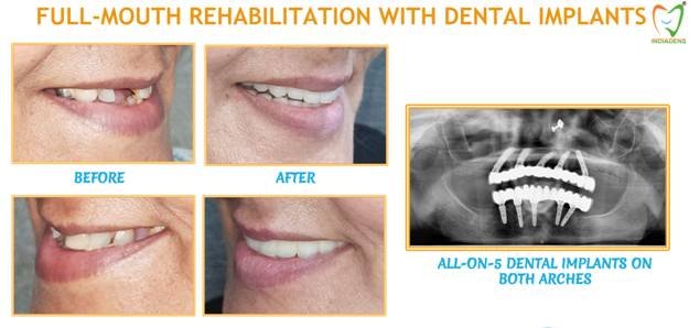 Full Mouth Dental Implants Rehabilitation
