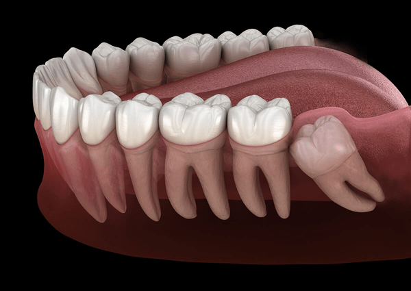 Myth Impacted Wisdom Tooth Does Not Need to Be Removed