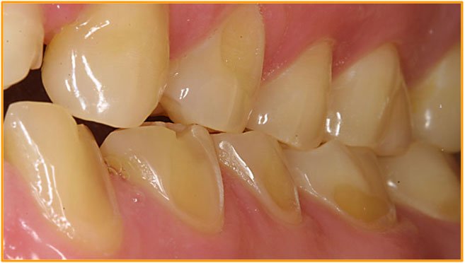 Tooth Enamel Erosion