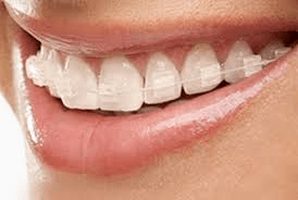 ceramic braces orthodontic treatment