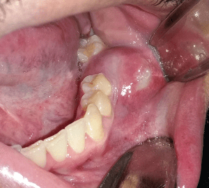 Dental Cyst Treatment at Indiadens Dental Clinic Delhi India