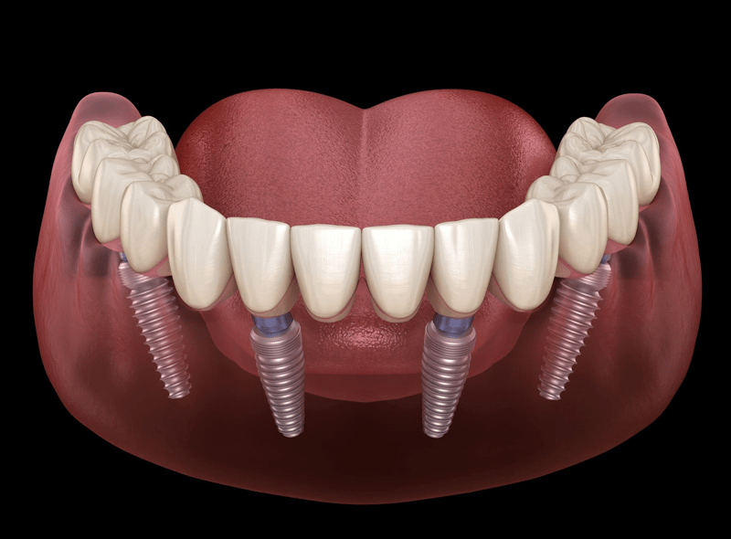 all on 4 dental implants treatment at Indiadens