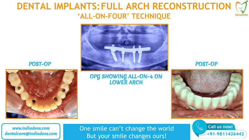 all on four technique for dental implant full arch reconstruction