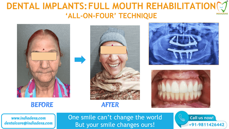 all on four technique for dental implant