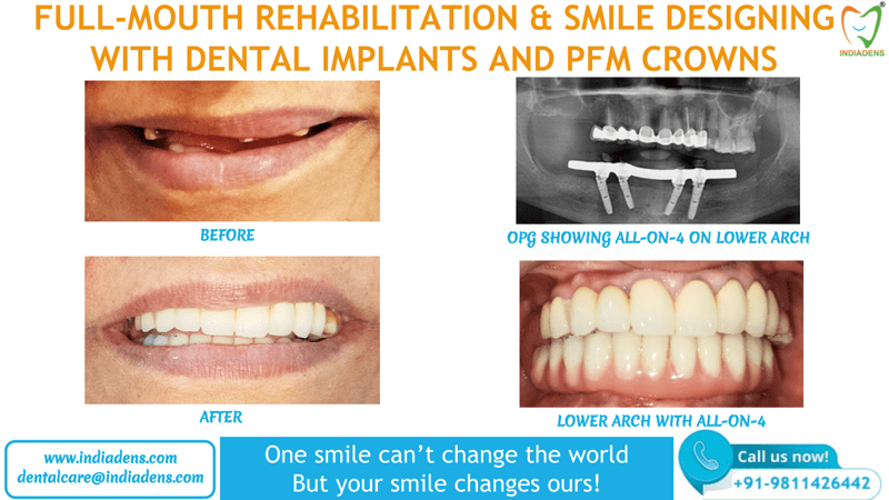 smile designing with dental implant and pfm crowns