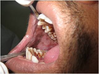 ORAL SUBMUCOUS FIBROSIS INDIADENS DENTAL CLINIC DELHI INDIA