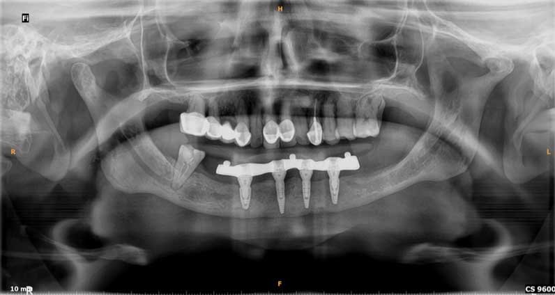 Implant-Supported Teeth OPG