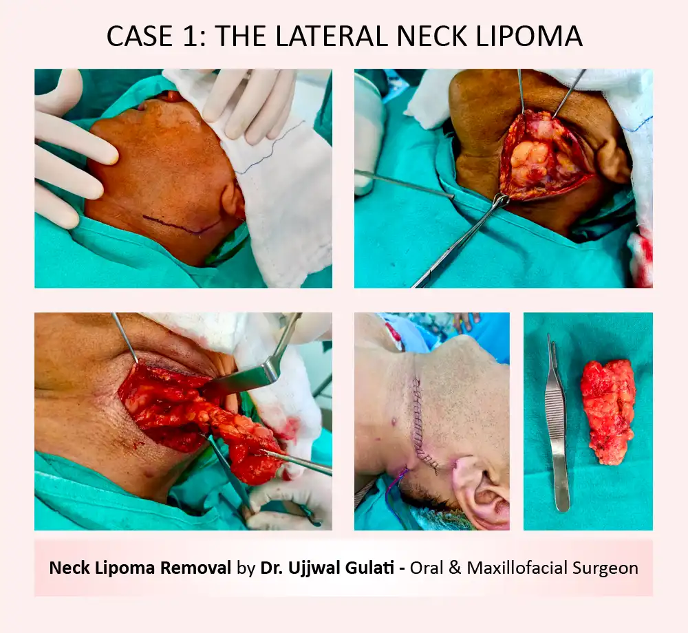 case1: Neck Lipoma Removal by Dr Ujjwal Gulati