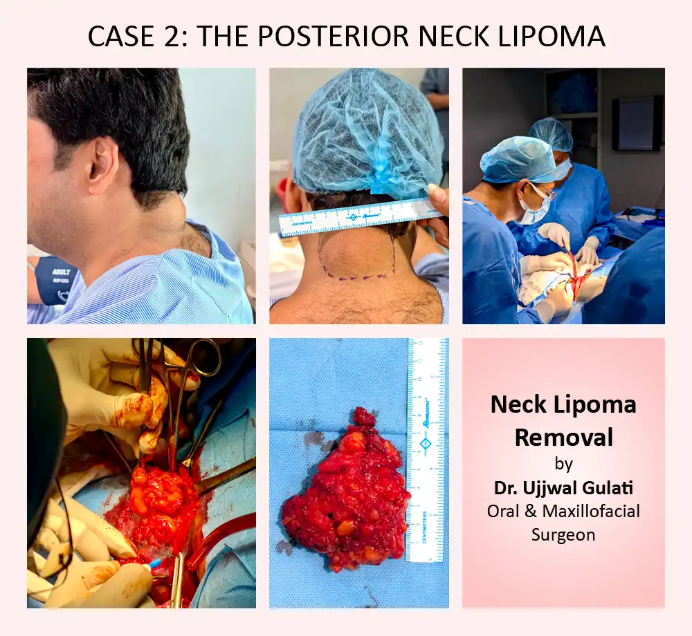 case2: Neck Lipoma Removal by Dr Ujjwal Gulati