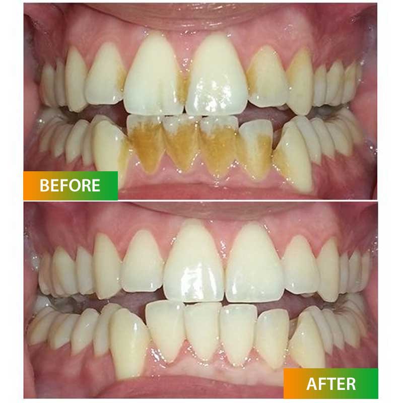 Tartar Teeth Treatment