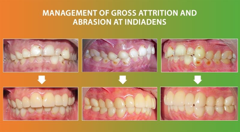 Gross Attrition and Abrasion