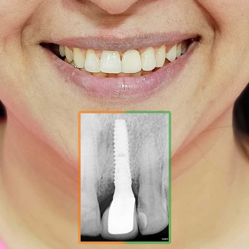 Single Anterior Tooth Implant of Harita Kaul