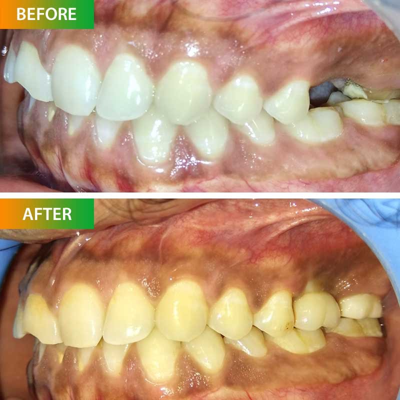 Single Tooth Implant of Abhineet