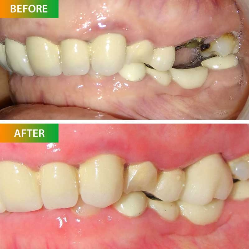 Single Tooth Implant of Saroj Damani