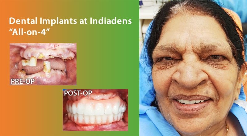 Full mouth dental implants all on 4 rehabilitation at Indiadens, Delhi