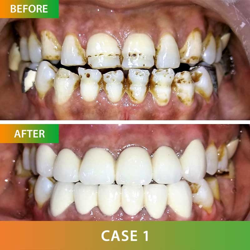 Porcelain Dental Crown