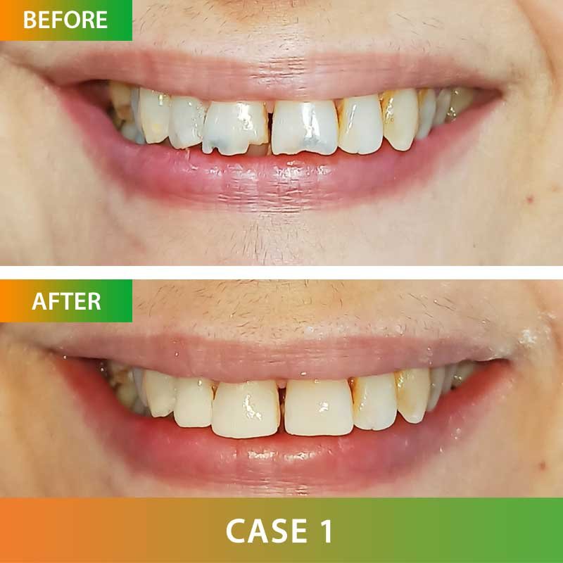 Dental Restoration