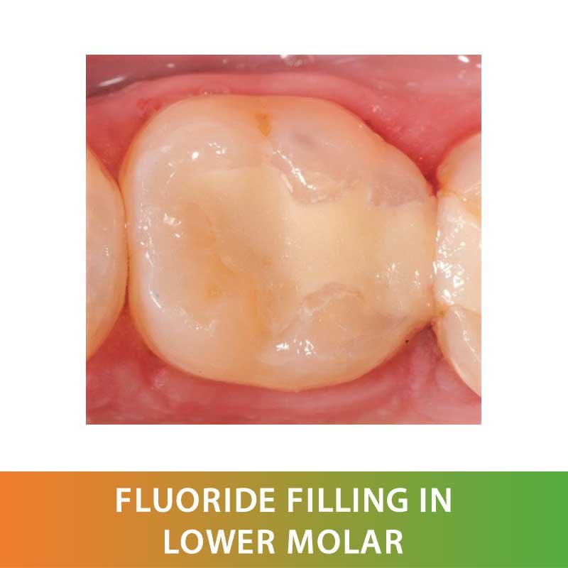 Dental Restoration Fillings Fluoride