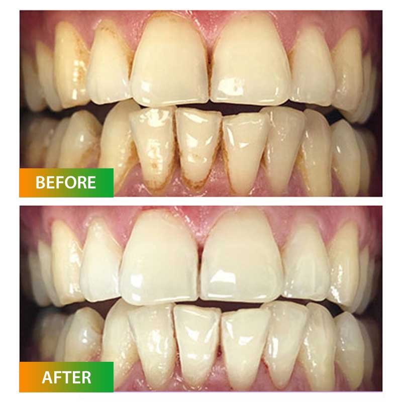 Scaling and Polishing
