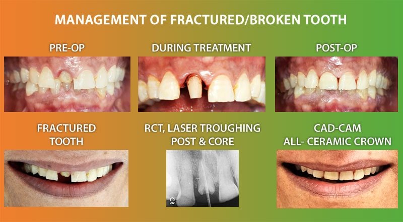 Broken Tooth Treatment